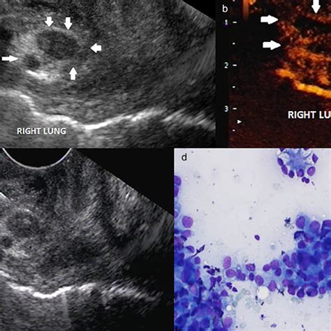 A Endoscopic Ultrasound Eus Well Defined Rounded And Hypoechoic Download Scientific