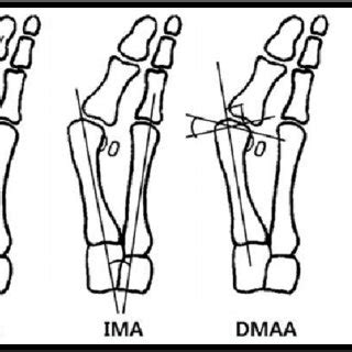 Radiographic Parameter Of The Hallux Valgus Dmaa Distal Metatarsal