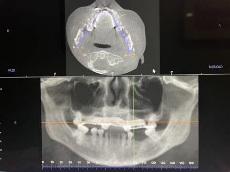 Before And After Quincy Ma South Shore Oral Surgery Associates