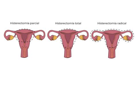 Histerectom A Viamed Salud