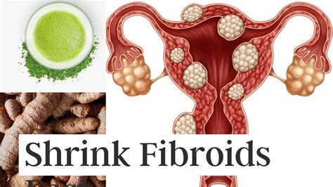 3 Ways To Shrink Fibroids Naturally Without Surgery Youtube