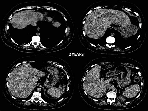 Multifocal Fatty Liver Metamorphosis Pacs