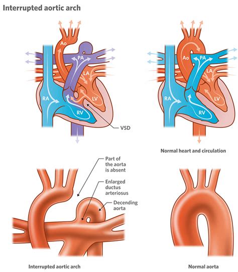 Interrupted aortic arch causes, types, symptoms, diagnosis, treatment & survival rate