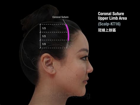 Scalp Kt Coronal Suture Upper Limb Area Master Tung S Acupuncture