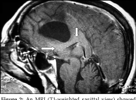 Figure 1 From Intracranial Symptomatic Giant Arachnoid Cyst Of The Interhemispheric Fissure