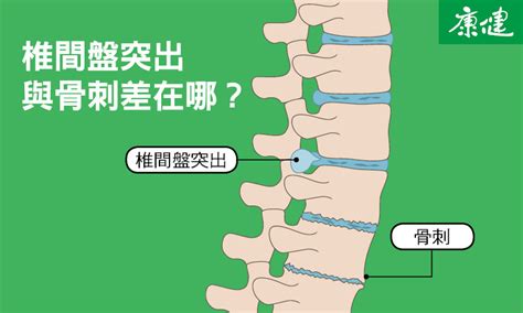 椎間盤突出原因、症狀測試，9招自然改善椎間盤突出 康健雜誌