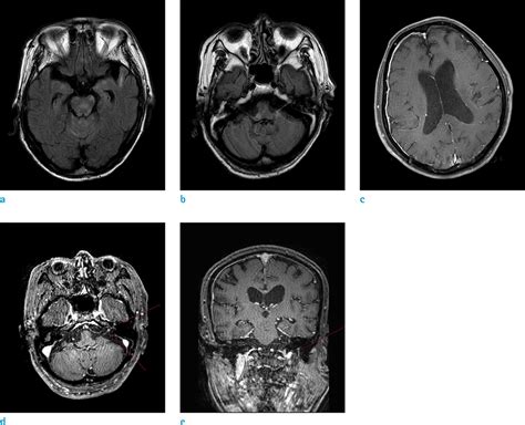 Ramsay Hunt Syndrome Complicated By Meningoencephalitis And Radiologic Findings A Rare Case Report