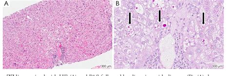 Figure 1 from Alpha-1 antitrypsin deficiency liver disease. | Semantic ...