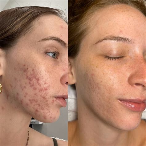 Acne Bootcamp — Golden Hour Skincare