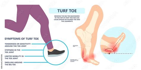 Turf Toe: Symptoms & Treatment - Paul Miller Podiatry