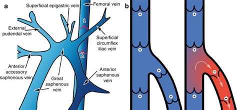 Venous Reflux Worksheet