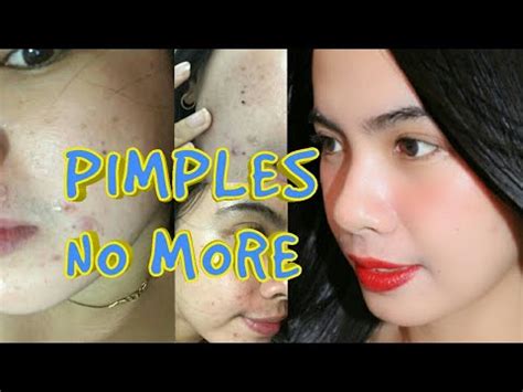 GAMOT SA PIMPLES NA MAY NANA YouTube