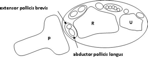 Ultrasound Guided Injections For De Quervains Tenosynovitis Pmc