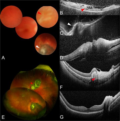 Ophthalmic Images From Case 2 At Presentation Despite The Vitritis