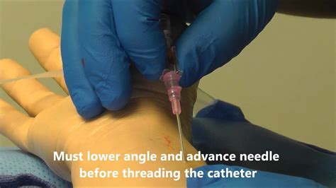 Arterial Line Insertion Youtube