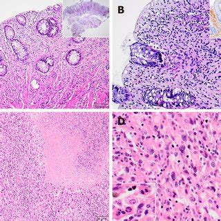 Histopathology Of Schwann Cell Hamartoma And Malignant Peripheral Sheet