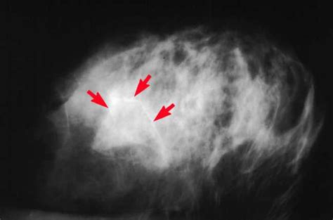 Breast Calcifications on Your Mammogram