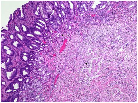 Gastric Inflammatory Fibroid Polyp A Rare Cause Of Occult Upper