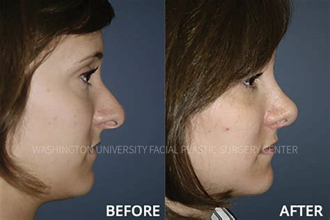 Before And After Facial Plastic Surgery Center Washington