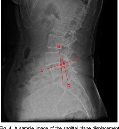 Figure 1 From Reliability And Validity Of The Side Lying Instability