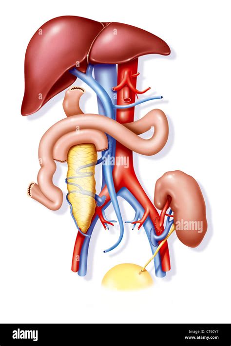 KIDNEY-PANCREAS TRANSPLANT, ILL Stock Photo - Alamy