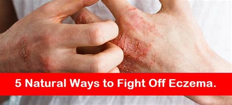 5 Natural Ways To Fight Off Eczema