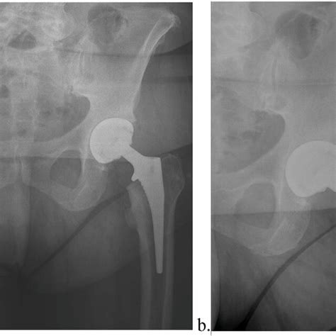 A Anteroposterior View Of The Pelvis And B Lateral View Of The Left Download Scientific