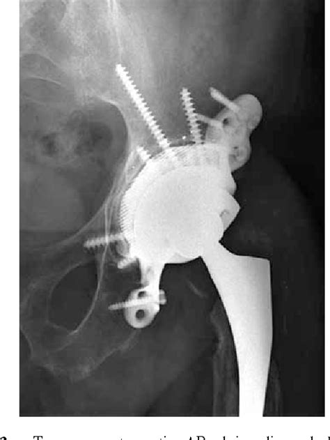 Figure 2 From A Modified Custom Made Triflanged Acetabular