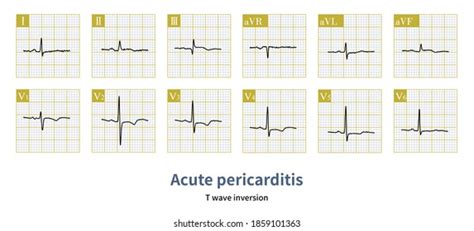 Pericarditis Ecg Images Stock Photos Vectors Shutterstock