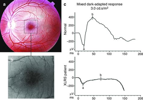 10 Macular And Electroretinographic Characteristics Of XLRS A The