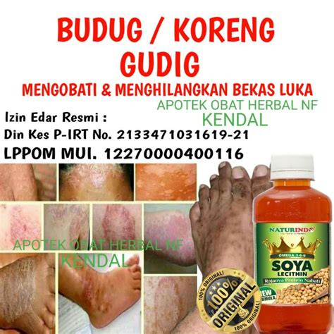 Jual Obat Budug Koreng Obat Budug Di Kaki Obat Budug Santri Obat