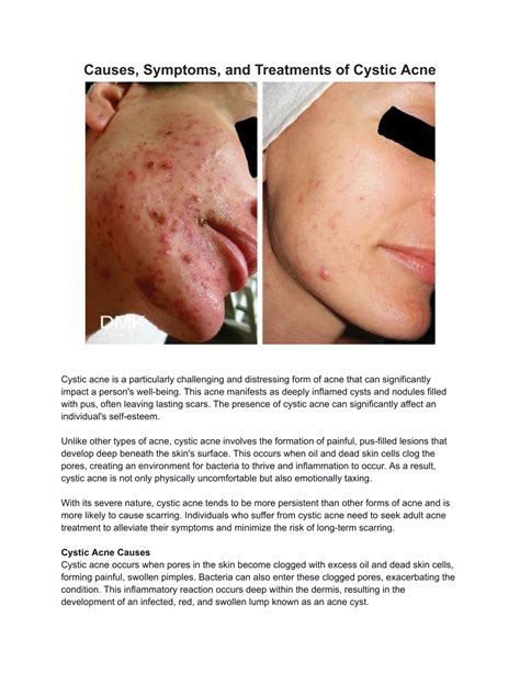 Ppt Causes Symptoms And Treatments Of Cystic Acne Dmk Powerpoint