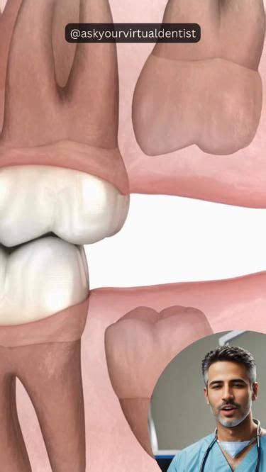 When And Why To Remove Wisdom Teeth Artofit