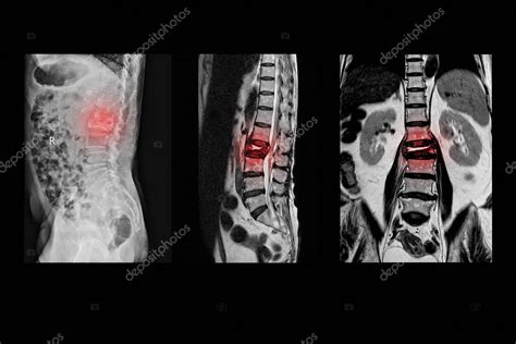 Resonancia Magn Tica De La Columna Lumbar Antecedentes De Ca Da Con