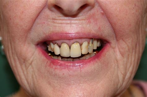 Before And After Miramar Village Dental White Rock Dentist