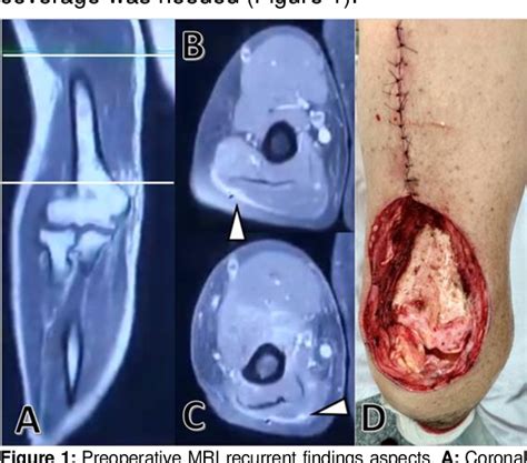 Figure From Latissimus Dorsi Transfer For Triceps Brachii