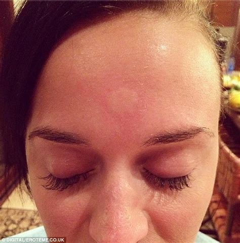 Katy Perry shows off huge mosquito bite right in the centre of forehead ...