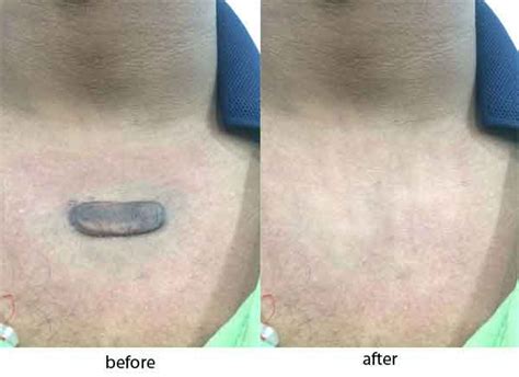 Keloid Removal Treatment Pune - Cryotherapy & Flurouracil bleomycin