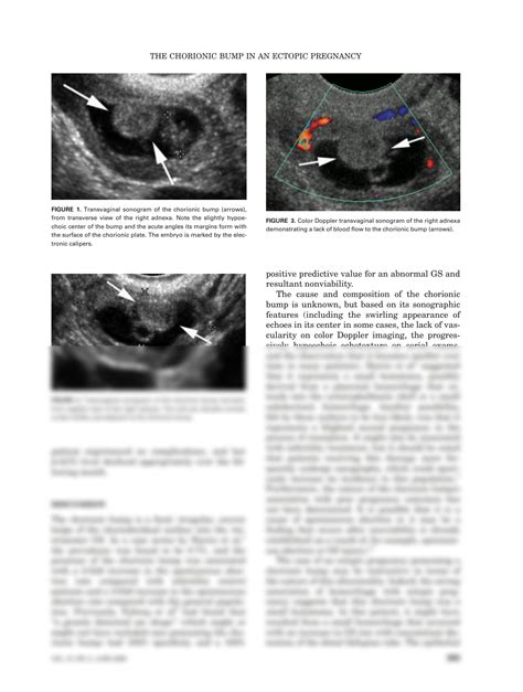 Solution The Chorionic Bump In An Ectopic Pregnancy Abnormal Gestational Sac Shape Chorionic