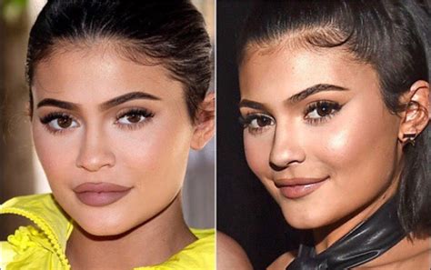 How did Kylie Jenner Reduce her Lip Size?