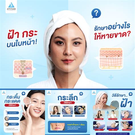 ปัญหาฝ้า กระ รักษาอย่างไรให้หายขาด Attitude Clinic คลินิกความงาม