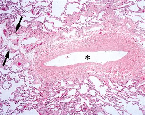 Pulmonary Artery Histology