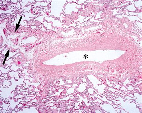 Pulmonary Artery Histology