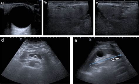 Ultrasound Images Of Extrarenal And Renal Manifestations No