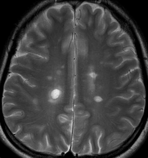 Ms Brain Mri With Contrast