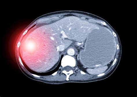 Liver Lesions Types Diagnosis And Treatment