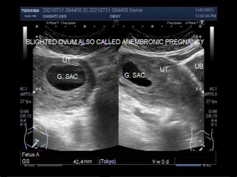 Two Cases Of Blighted Ovum Also Called Anembryonic Pregnancy Youtube