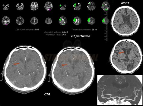 Ct Perfusion Ctp Stroke Manual