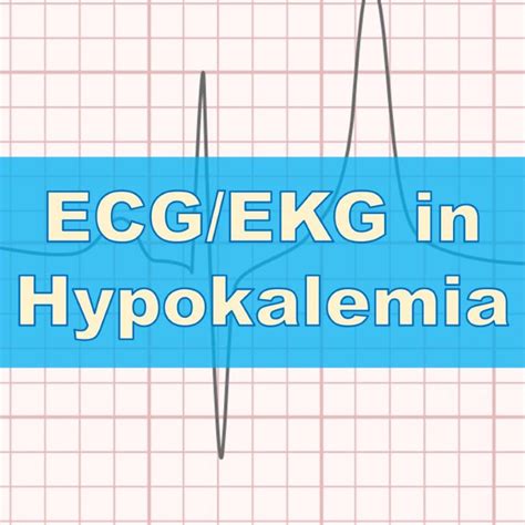 Hypokalemia Ecg Ekg Rish Academy