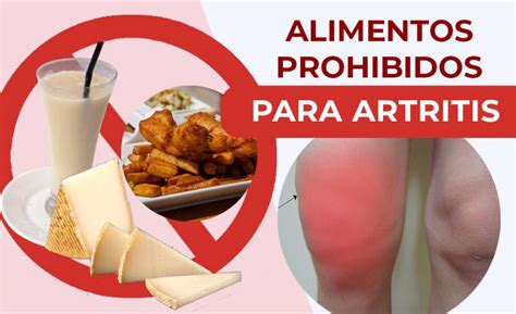 3 Alimentos Prohibidos Para La Artritis Que Aumentan El Dolor En Las Articulaciones Nuevas Evas